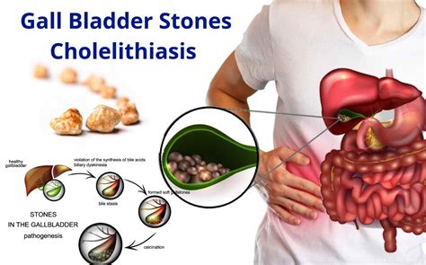 Find Relief From Pain and Discomfort After Gallbladder Removal: A Guide to Healing From Gallstones